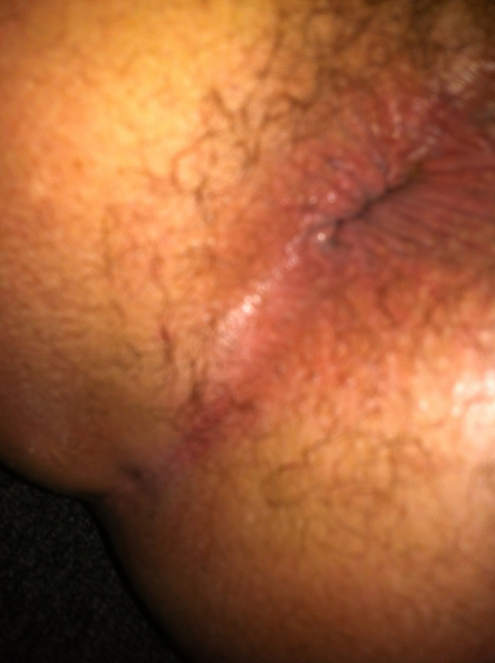 Whats anal bleaching